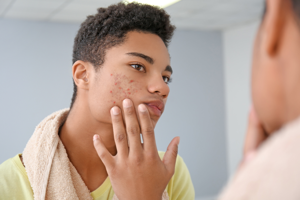 The Best Oils for Acne Prone Skin