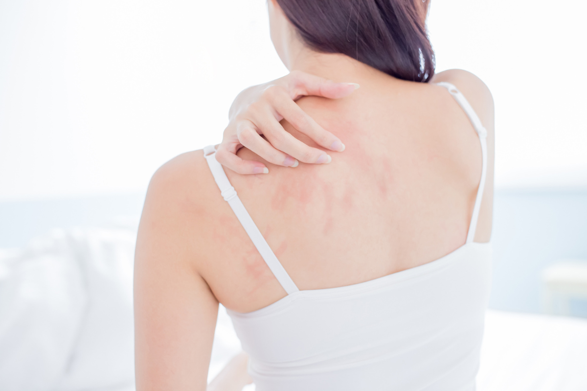 Essential Oils for the Treatment of Eczema